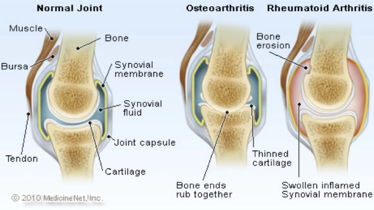 Cartilagine di Squalo: Il Rimedio Naturale per l'Artrite e il Sollievo dal Dolore Articolare!